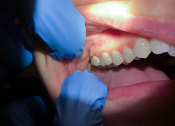 Best Emergency Dental Extractions in Mahanoy City, PA